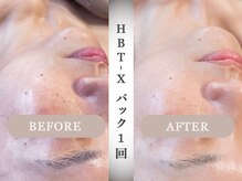 モルティー 宇都宮東店(Molti)/肌質改善/しみ/引き締め/HBT-X