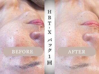 モルティー 宇都宮東店(Molti)/肌質改善/しみ/引き締め/HBT-X