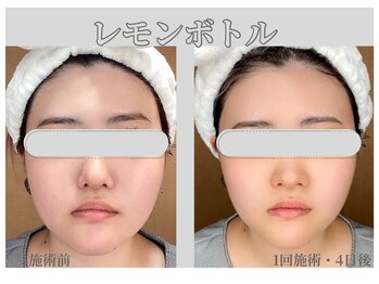 ルーチェ カリーノ(Luce Carino)の写真/横顔・フェイスラインに自信を。写真映えする小顔ケア