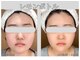 ルーチェ カリーノ(Luce Carino)の写真/横顔・フェイスラインに自信を。写真映えする小顔ケア