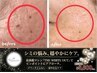 [新規]高周波ポイントシミケア♪30分当て放題！￥13900→￥12800！！
