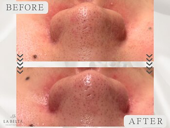 エステティックサロン ラ ベルタ(Esthetic Salon La Belta)/ハーブトリートメント5回