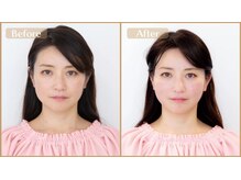 グラン治療院 東京/美容鍼　ビフォーアフター