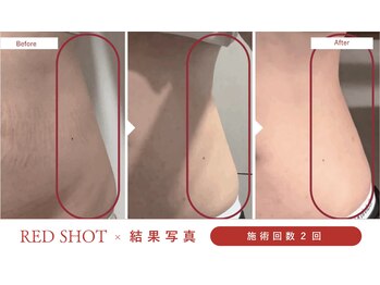 ハレア(HALEA)/レッドショット腹部 6cc B/A