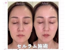 シェルドール 大阪心斎橋セルラム(shelld'Or)の雰囲気（セルラム当日の効果→目のクマ解消フェイスラインはリフトアップ）