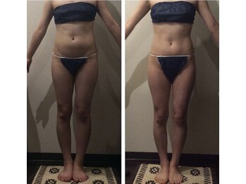 アーラ アンド べレア(ALA & Bellea)の写真/本格痩身のハイパーナイフで憧れのサイズダウンを目指して理想の自分に出会うケアを体験◎