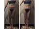 アーラ アンド べレア(ALA & Bellea)の写真/本格痩身のハイパーナイフで憧れのサイズダウンを目指して理想の自分に出会うケアを体験◎