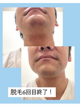 リル(Lil)/ヒゲ脱毛12回中の6回経過！