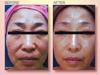 ジュリア オージェ 梅田店/ビフォーアフター/イドラリフト