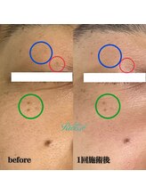 サロンリー(Salon Riee)/シミケア