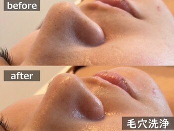 ココモンド(COCOMONDO)/ハイドロ毛穴洗浄/毛穴/毛穴洗浄