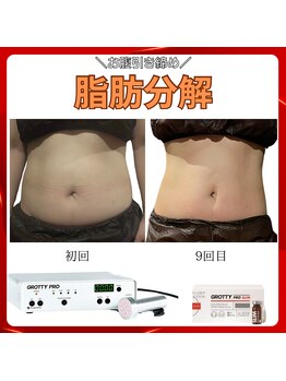 トータルビューティーサロン ヴィヴィエ(ViVier)/脂肪分解　お腹スリム症例9回