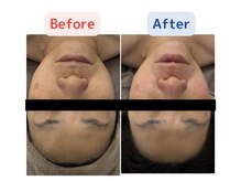 ソルーブ 広尾店/¥地域最安値/韓国肌育ピーリング