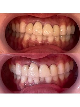 ルアナ 武蔵小杉店(Luana)/医療提携セルフホワイトニング