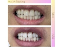 エクシア ホワイトニング 伊勢崎店/