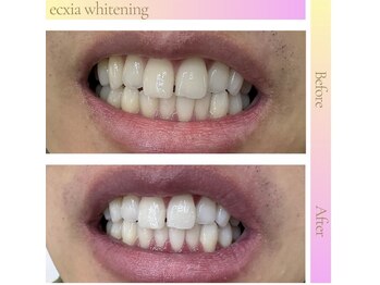 エクシア ホワイトニング 伊勢崎店/