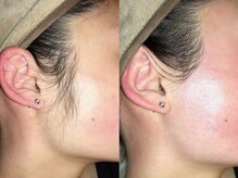 シンボディメイク 恵比寿(SiN BODY MAKE)/【横顔美人に】もみあげワックス