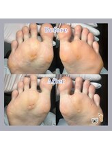 巻き爪補正店 天王寺店/女性も男性も、足裏スッキリ！