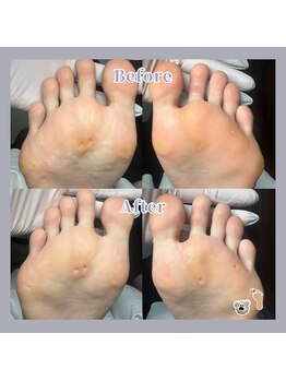 巻き爪補正店 天王寺店/女性も男性も、足裏スッキリ!