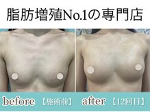 サラエクセレント 銀座/デコルテふっくら丸みが綺麗に！