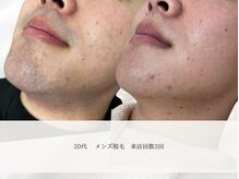 エメ(aimer)/EPI《脱毛》