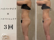 サロン ド ソワ(Salon de Soie)/ハイパーナイフ×シェイプ