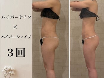 サロン ド ソワ(Salon de Soie)/ハイパーナイフ×シェイプ