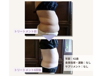 フェムプリュ(femplus)/サーモシェイプオーパスボディ