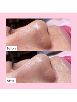 ホワイトラボ 四条烏丸(White labo)/【施術例】ハイドロフェイシャル