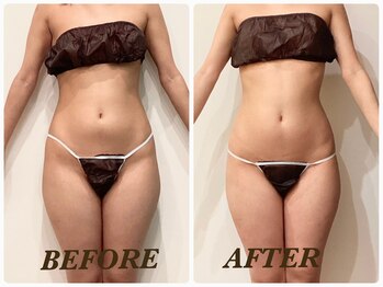 プリマ(Prima)/【2回施術】 BEFORE&AFTER