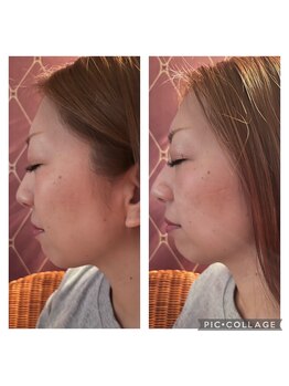 エステサロンケードット(Esthetic Salon K.)/小顔調整コース
