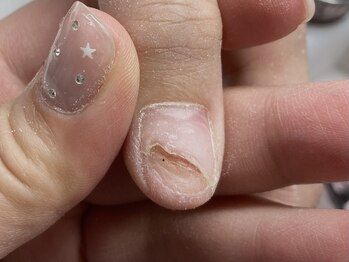 爪処 中野坂上/トラブル爪