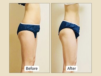 ミリュー(mylieu)/まずは3日連続で痩身効果倍速★