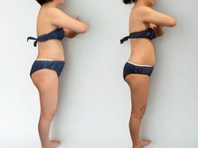 サルサナ(Salu Sana)/before→after　痩身/温熱