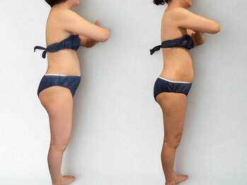 サルサナ(Salu Sana)/before→after　痩身/温熱