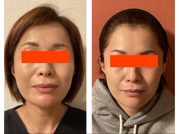 ロイヤリティ(ROYALTY)/フェイスライン/くいしばり