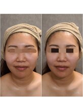 ウォーマル(warmaL)/小顔矯正/印象もパッと変わる！