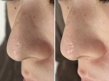 リッチ(Rich+)/ハイドラフェイシャル