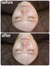 ウララ(ulala)/セラピールビフォアフ