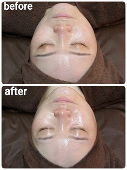 ウララ(ulala)/セラピールビフォアフ