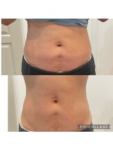 ルナート(Lunart)/腸もみの一回の変化