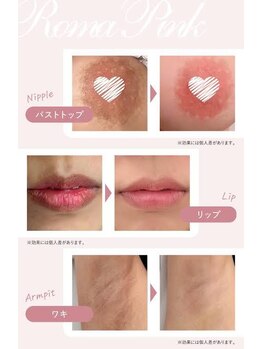 プリュベル(+belle)/◇ローマピンク before after◇