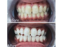 ホワイト 福岡天神店(WHITE)/ホワイトニングビフォーアフター