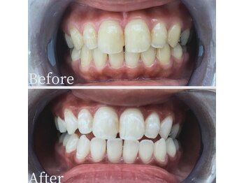 ホワイト 福岡天神店(WHITE)/ホワイトニングビフォーアフター