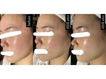 ポノ(PONO)の雰囲気（水光ピーリングで赤み・ニキビ肌改善艶と透明感のある水光肌に）