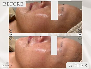 エステティックサロン ラ ベルタ(Esthetic Salon La Belta)/毛穴トリートメント