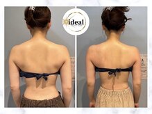 アイディール(ideal)/脂肪減少10ミリコース