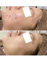 ニキビ研究所 千葉店/お顔全体のニキビケア