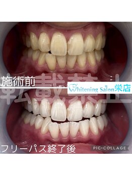 ホワイトニングサロン 名古屋 栄店/【ホワイトニング】