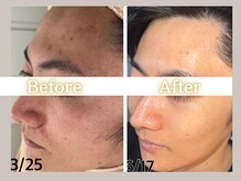 ハル(HARU.)/ハーブピーリング